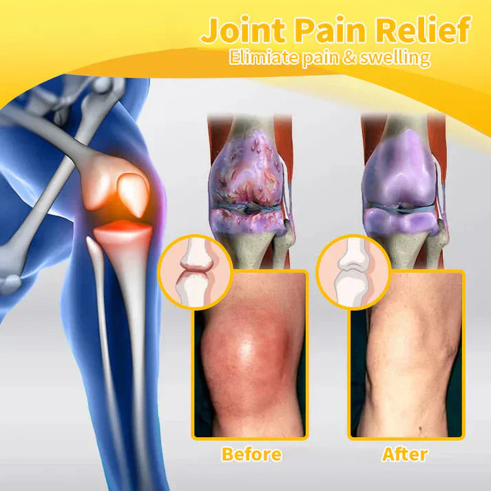 ✅Official Store: flysmus™ Bee-Venom Pain-Relief Bone Healing Cream👨⚕️British Osteopathic Medical Association (BOA) Approved(Reducing joint swelling, pain, stiffness, redness, warmth, soreness, and joint fatigue)