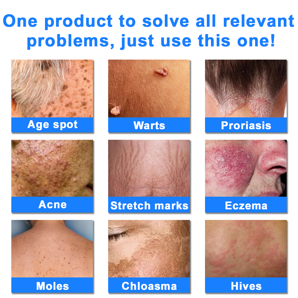 ✅NHS Approved: Ourlyard® Skin Treatment Cream(Relieves dermatitis, eczema, psoriasis, pigmentation, dry skin, and other common skin issues)