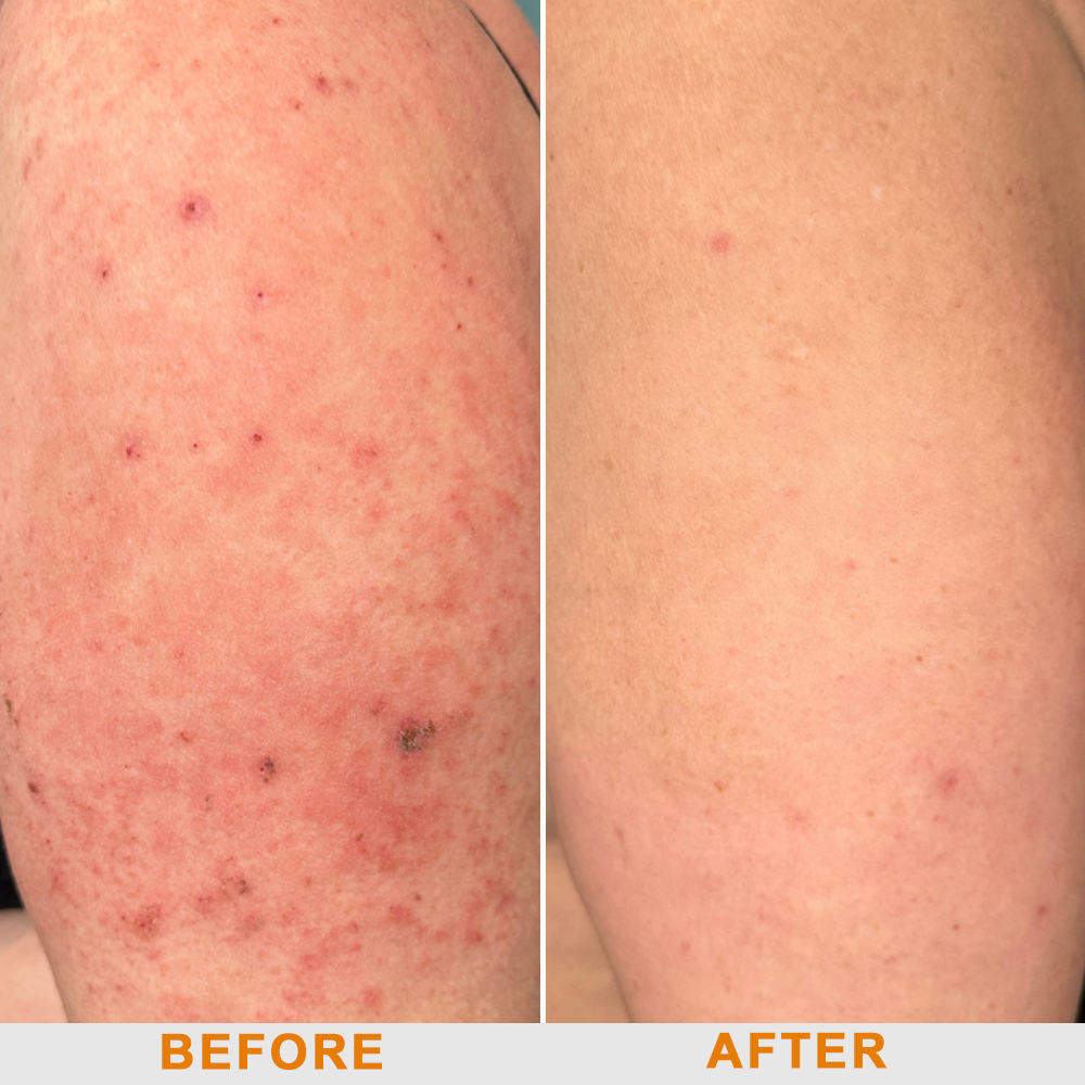 OurlyardÂŽ Official Store: Bee Venom Skin Treatment Creamđ¨ââď¸British Association of Dermatologists (BAD) Approved