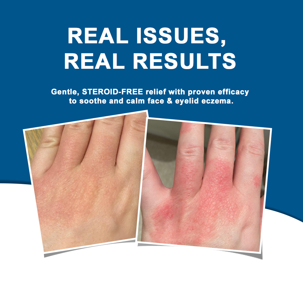 ✅NHS Approved: Ourlyard® Skin Treatment Cream(Relieves dermatitis, eczema, psoriasis, pigmentation, dry skin, and other common skin issues)