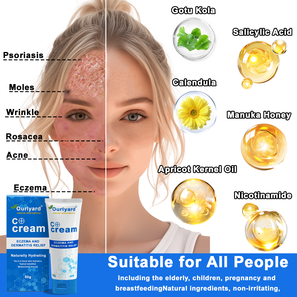 ✅NHS Approved: Ourlyard® Skin Treatment Cream(Relieves dermatitis, eczema, psoriasis, pigmentation, dry skin, and other common skin issues)