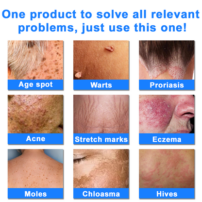 ✅NHS Approved: Ourlyard® Eczema Cream Skin Treatment(Relieves eczema, dermatitis, psoriasis, skin allergies, skin irritation, pigmentation, dry skin, and other common skin issues.)