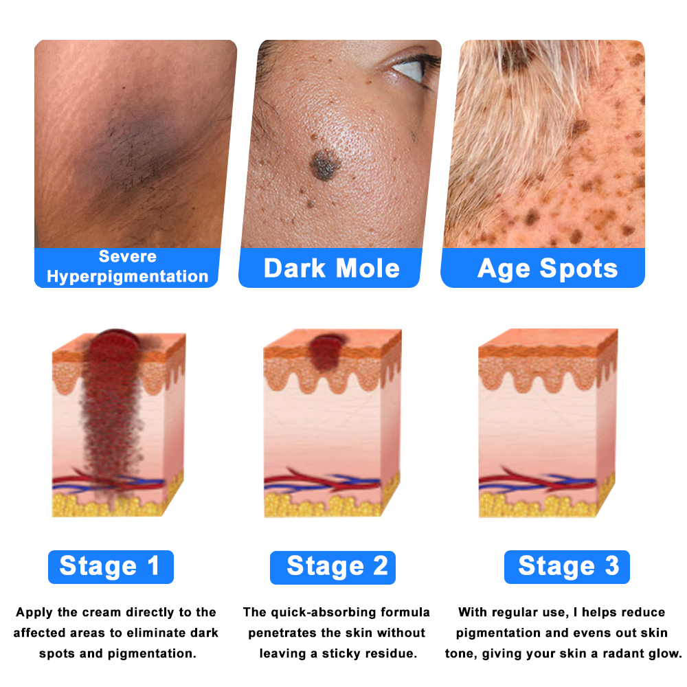 ✅NHS Approved: Ourlyard® Eczema Cream Skin Treatment(Relieves eczema, dermatitis, psoriasis, skin allergies, skin irritation, pigmentation, dry skin, and other common skin issues.)