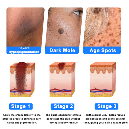 ✅NHS Approved: Ourlyard® Eczema Cream Skin Treatment(Relieves eczema, dermatitis, psoriasis, skin allergies, skin irritation, pigmentation, dry skin, and other common skin issues.)