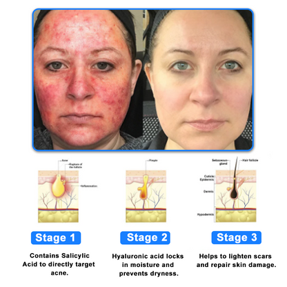 ✅NHS Approved: Ourlyard® Eczema Cream Skin Treatment(Relieves eczema, dermatitis, psoriasis, skin allergies, skin irritation, pigmentation, dry skin, and other common skin issues.)