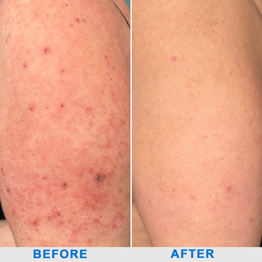 ✅NHS Approved: Ourlyard® Eczema Cream Skin Treatment(Relieves eczema, dermatitis, psoriasis, skin allergies, skin irritation, pigmentation, dry skin, and other common skin issues.)