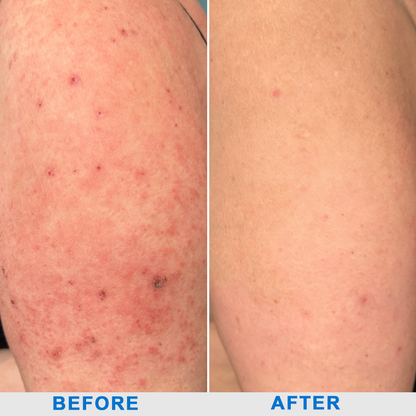 ✅NHS Approved: Ourlyard® Eczema Cream Skin Treatment(Relieves eczema, dermatitis, psoriasis, skin allergies, skin irritation, pigmentation, dry skin, and other common skin issues.)
