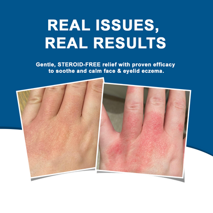 ✅NHS Approved: Ourlyard® Eczema Cream Skin Treatment(Relieves eczema, dermatitis, psoriasis, skin allergies, skin irritation, pigmentation, dry skin, and other common skin issues.)